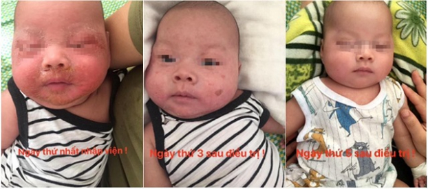   Bé trai 4 tháng nhiễm tụ cầu bị loét da mặt vì mẹ đắp thuốc lá theo dân gian  