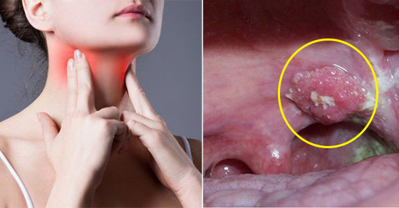   5 dấu hiệu cảnh báo ung thư vòm họng dễ nhầm với cảm cúm thông thường  