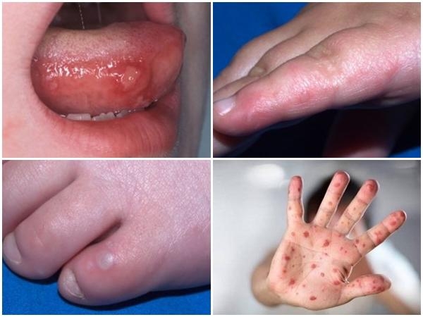   Dấu hiệu đặc trưng của bệnh tay chân miệng là sốt, đau họng, tổn thương niêm mạc miệng và da, chủ yếu ở dạng phỏng nước ở tay, chân. Ảnh minh họa  