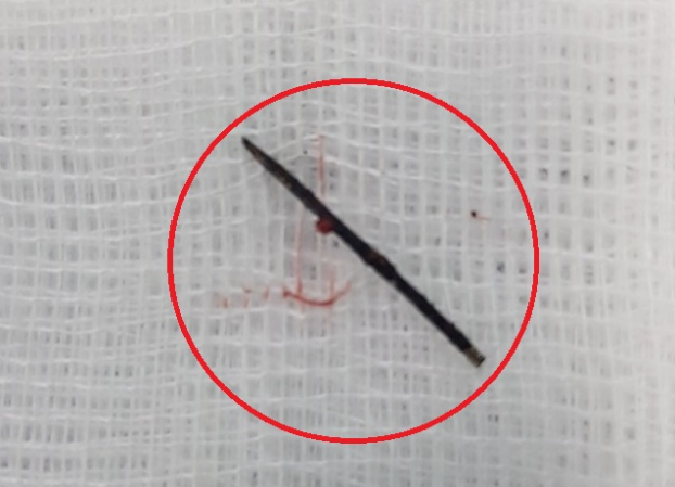   Kim khâu dài 17mm đã bị gỉ đen được lấy ra từ cơ thể em bé  