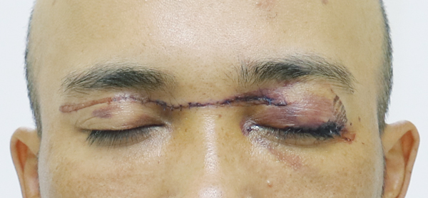   Bệnh nhân được khâu tạo hình mi trên mắt, khâu vết thương mặt  