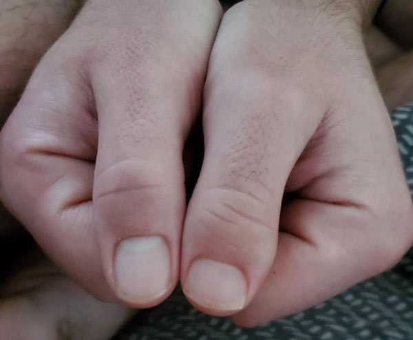   2 ngón tay cái ở hai bàn tay của tôi trông khác nhau hoàn toàn.  