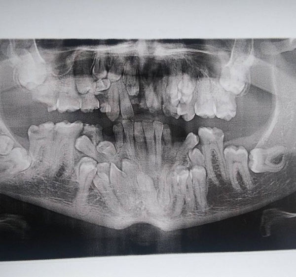   Tôi mắc chứng loạn dưỡng chất trong sọ, một hội chứng rối loạn hiếm gặp. Đây là bức ảnh chụp X-quang nha khoa đầu tiên của tôi, hóa ra tôi có rất nhiều răng thừa.  