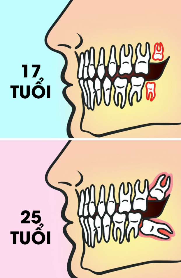 Răng khôn có nhất thiết phải nhổ hay không? 1