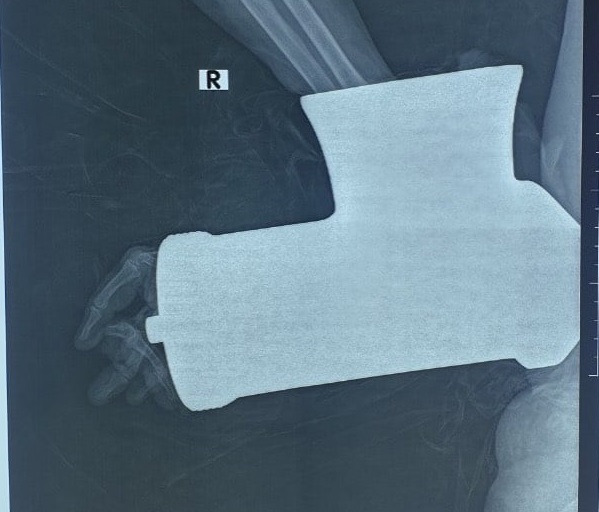   Hình ảnh chụp bàn tay phải của bệnh nhân bị cuốn vào máy xay thịt  