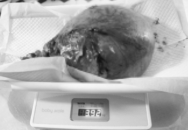   Khối u khủng nặng gần 4kg được lấy ra từ bụng bệnh nhân  