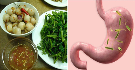 1 loại vi khuẩn là sát thủ gây ung thư dạ dày, có nhiều trong 3 món người Việt ăn mỗi ngày 0