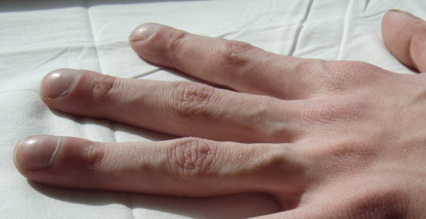4 dấu hiệu trên bàn tay cảnh báo ung thư ác tính, chú ý nhất là phổi và gan 2