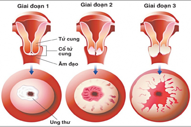   Ung thư cổ tử cung thường được phát hiện qua khám sàng lọc, nội soi cổ tử cung. Ảnh minh họa  