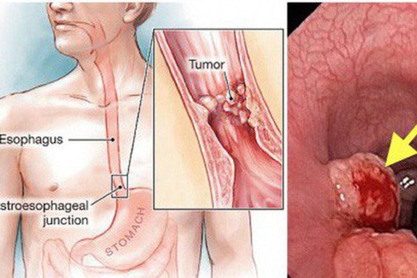 5 bộ phận cơ thể dễ trở thành 'mục tiêu' của ung thư, ai cũng nên cẩn thận 4