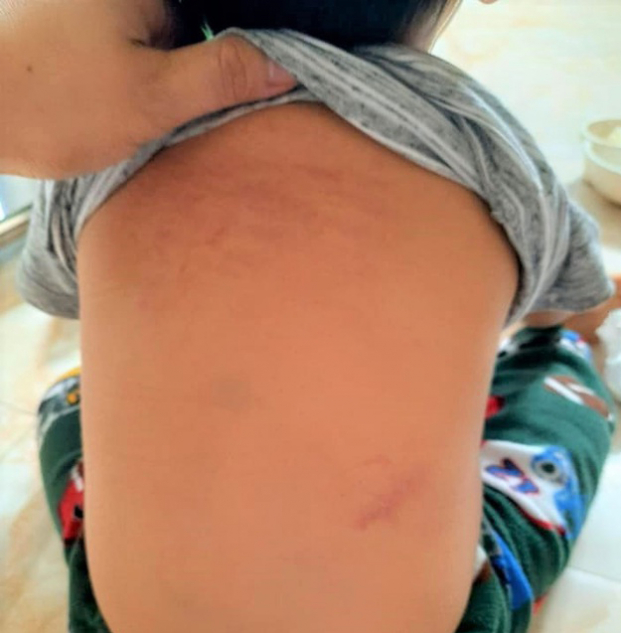   Hình ảnh thâm tím trên lưng bé H do bị cô giáo đánh.  