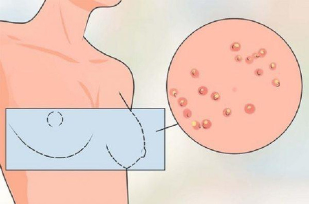 3 triệu chứng không đau báo hiệu ung thư vú, thấy quầng ngực có mụn phải đi khám ngay 3