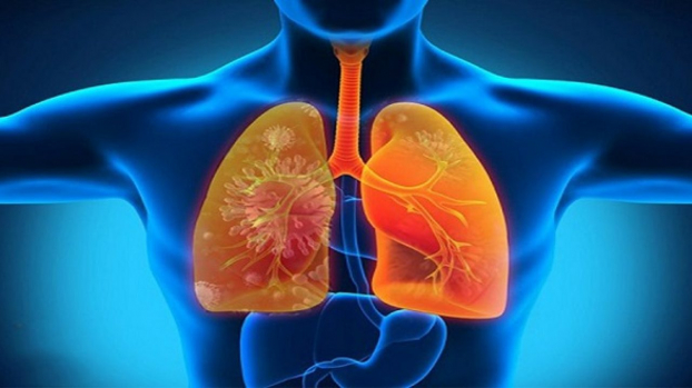   Bệnh viêm phổi nếu không được chẩn đoán và điều trị kịp thời rất dễ dẫn đến biến chứng nguy hiểm, thậm chí gây tử vong. Ảnh minh họa  