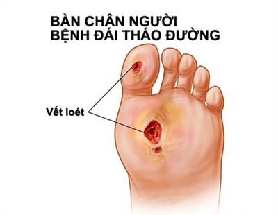 7 dấu hiệu trên da báo hiệu bệnh tiểu đường, thấy nổi mụn bất thường phải đi khám ngay 1