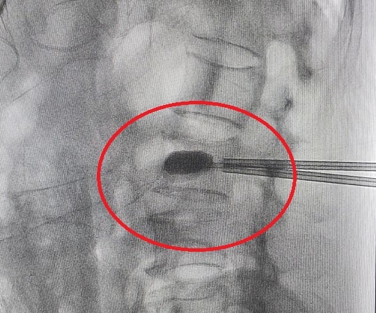   Hình ảnh gãy lún đốt sống L2 do tai nạn sinh hoạt trên phim chụp của bệnh nhân  