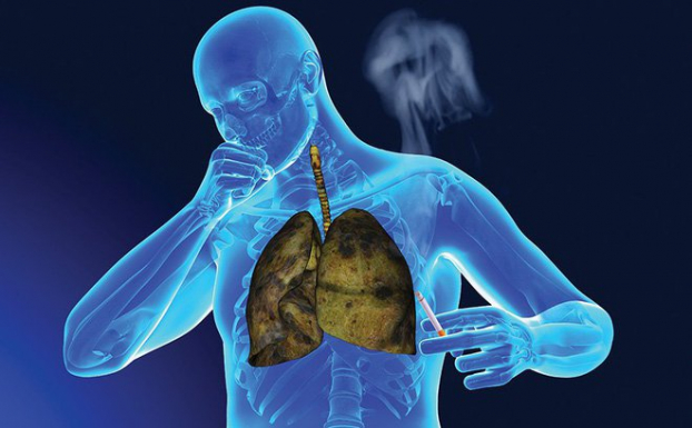 2 dấu hiệu khi ho cảnh báo ung thư phổi, nhưng hầu hết đều bỏ qua thời điểm vàng đi khám 1