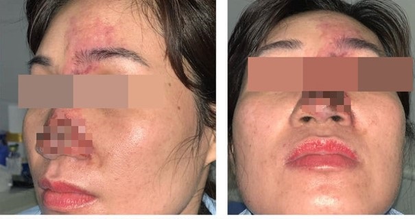   Người phụ nữ suýt mù mắt, mũi mưng mủ vì tiêm filler làm đẹp  