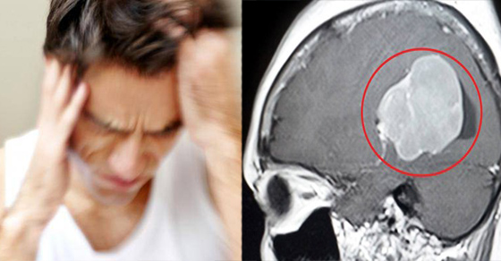 7 dấu hiệu cảnh báo não có khối u, một số biểu hiện dễ nhầm với bệnh vặt 0