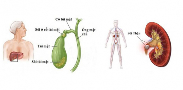   Sỏi mật không bài xuất qua đường nước tiểu như sỏi thận  