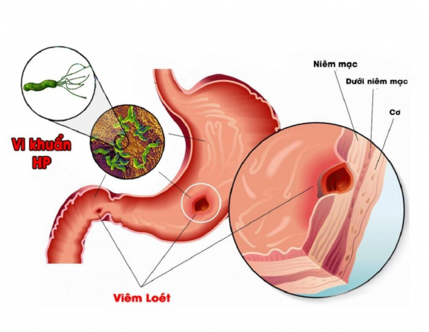   Vi khuẩn H.P là nguyên nhân chủ yếu gây loét dạ dày tá tràng và ung thư dạ dày. Ảnh minh họa  