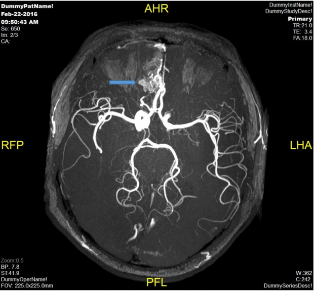   Hình ảnh dị dạng thông động tĩnh mạch vùng trán phải của một bệnh nhân nam 40 tuổi. Bệnh nhân đã được can thiệp nút khối dị dạng tại Vinmec và hồi phục sức khỏe tốt.  