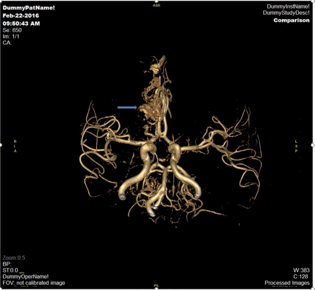   Hình ảnh chuỗi xung mạch não (MRA tof 3D) của một bệnh nhân nữ 54 tuổi sàng lọc mạch não phát hiện túi phình động mạch (vị trí mũi tên) và đã được can thiệp nút túi phình động mạch não phải tại Vinmec  