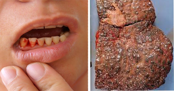 4 dấu hiệu trên miệng cảnh báo gan bị tổn thương nghiêm trọng 0