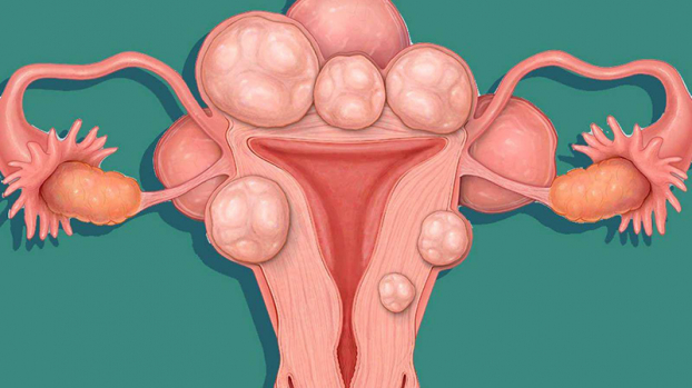   U xơ tử cung cũng là một trong những nguyên nhân gây ra vô sinh, hiếm muộn ở nữ giới. Ảnh minh họa  
