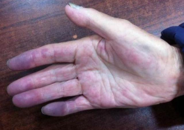 3 đặc điểm trên bàn tay chứng tỏ phổi bị tổn thương, ung thư đang ngấp nghé 0