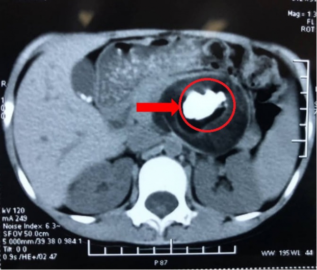   Hình ảnh khối u trên phim chụp CT-scanner  