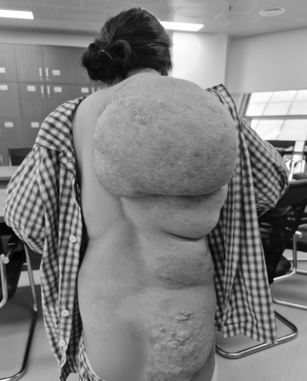   Khối u khủng trên lưng khiến bệnh nhân đi lại, vận động gặp rất nhiều khó khăn  