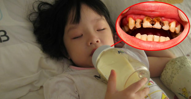 5 thói quen gây sâu răng, hô răng ở trẻ, cha mẹ cần uốn nắn ngay kẻo muộn 1