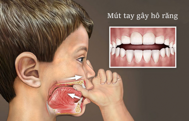 5 thói quen gây sâu răng, hô răng ở trẻ, cha mẹ cần uốn nắn ngay kẻo muộn 0