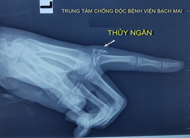   Hình ảnh chụp X.quang ngón tay của bệnh nhi thấy có nhiều hạt thủy ngân ở bên trong phần mềm sát khớp bàn ngón trỏ tay trái  