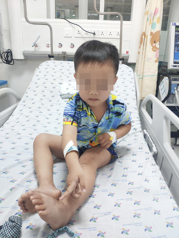   Cậu bé 4 tuổi bị trượt chân ngã vào bụi cỏ và đã bị rắn độc cắn phải vào viện cấp cứu  