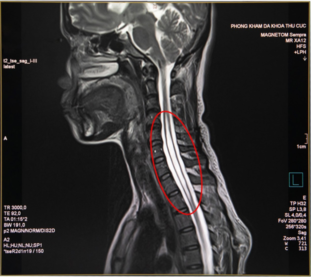   Hình ảnh chụp cộng hưởng từ của bệnh nhân H. cho thấy những tổn thương ở tủy sống khu vực cột sống cổ và ngực  