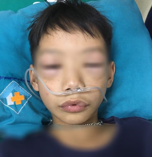   Bé trai 10 tuổi sốc phản vệ sau uống thuốc tự mua chữa ho, sốt phải vào viện cấp cứu  