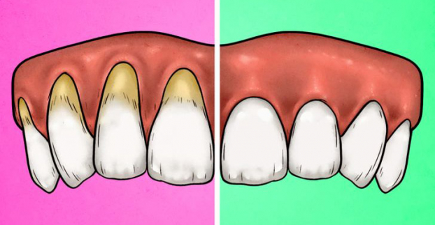 4 dấu hiệu chứng tỏ bạn đang đánh răng quá mạnh 0