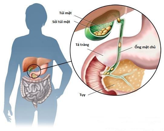   Sỏi mật nếu không được điều trị đúng cách sẽ gây ra nhiều biến chứng nguy hiểm. Ảnh minh họa  