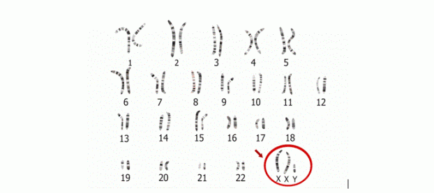   Hội chứng Klinefelter là một rối loạn di truyền ở nam giới, người bệnh có một cặp nhiễm sắc thể giới tính X thay vì chỉ có một nhiễm sắc thể X.  