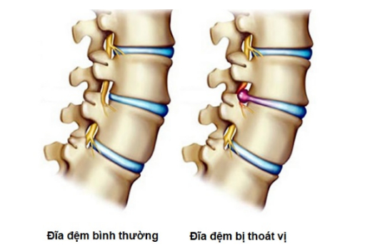   Quá trình thoái hóa, chấn thương hoặc thiếu hụt dinh dưỡng là căn nguyên gây thoát vị đĩa đệm  