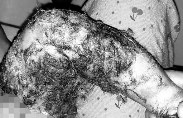   Thầy lang dùng lông động vật đắp lên vết bỏng khiến bệnh nhi bị nhiễm trùng nặng. Ảnh minh họa  