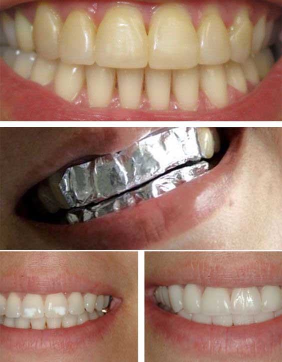 5 cách tự nhiên giúp bạn có hàm răng trắng sáng không cần đi thẩm mỹ 1