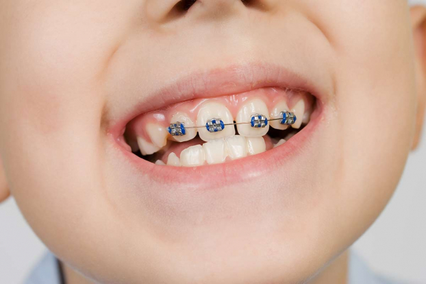 5 dấu hiệu trẻ cần niềng răng, cha mẹ lưu ý để can thiệp kịp thời 1