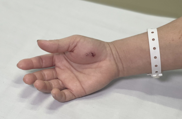   Hình ảnh vết cắn trên tay bệnh nhân  