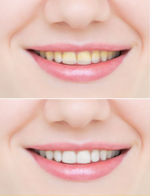 7 mẹo đơn giản để có hàm răng trắng sáng, khỏe mạnh ngay tại nhà 0