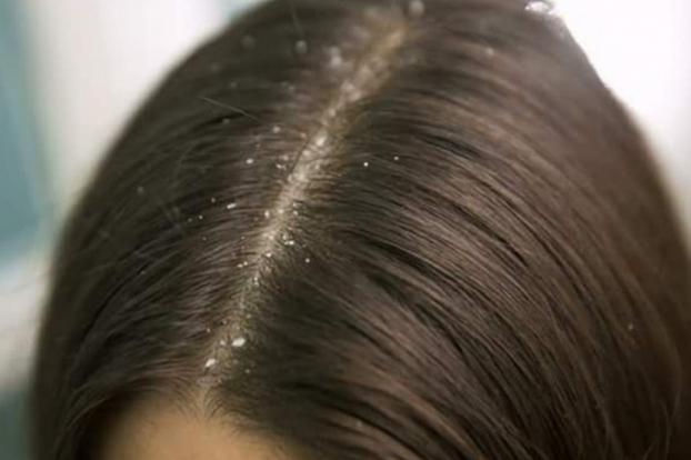 6 điều có thể xảy ra với mái tóc vào mùa đông và cách xử lý 5