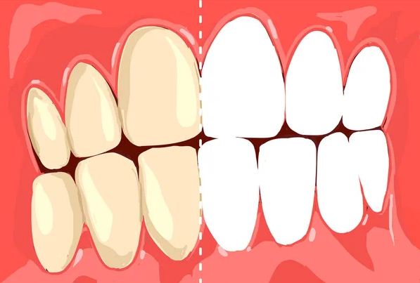 6 thói quen sai lầm khiến răng bị ố vàng dù vẫn đánh răng hàng ngày 0
