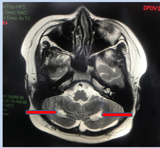   Hình ảnh cộng hưởng từ nhân (MRI) não cho thấy tổn thương chất trắng vùng tiểu não 2 bên gây hiện rối loạn phối hợp vận động, loạng choạng, thất điều  