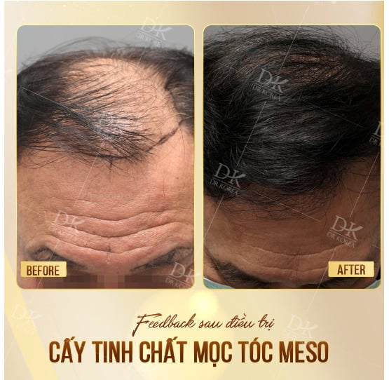   Khách hàng cấy tinh chất mọc tóc Meso tại Dr Korea  